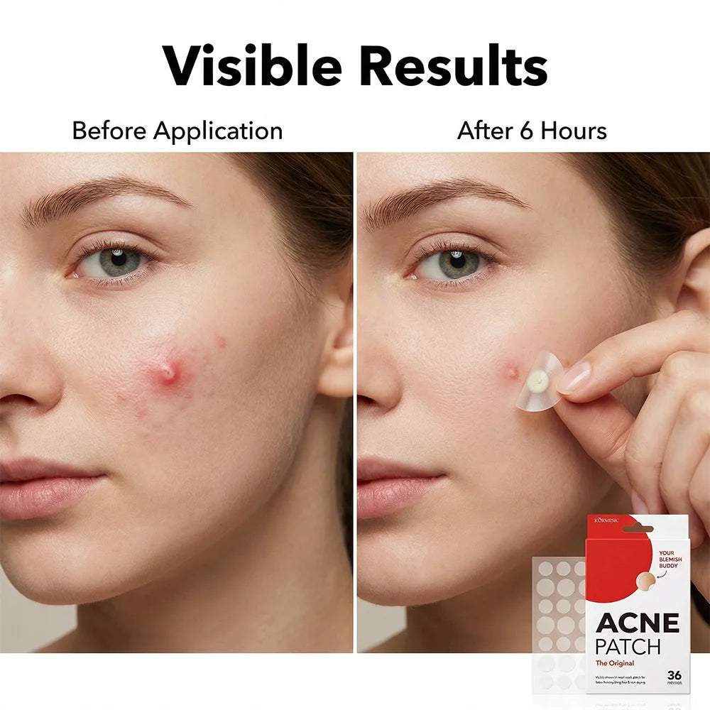 Invisible Acne Pimple Patches - 36pc Hydrocolloid Healing Stickers